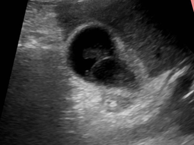 homeopathie vesicule biliaire